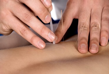 What is Dry Needling therapy?